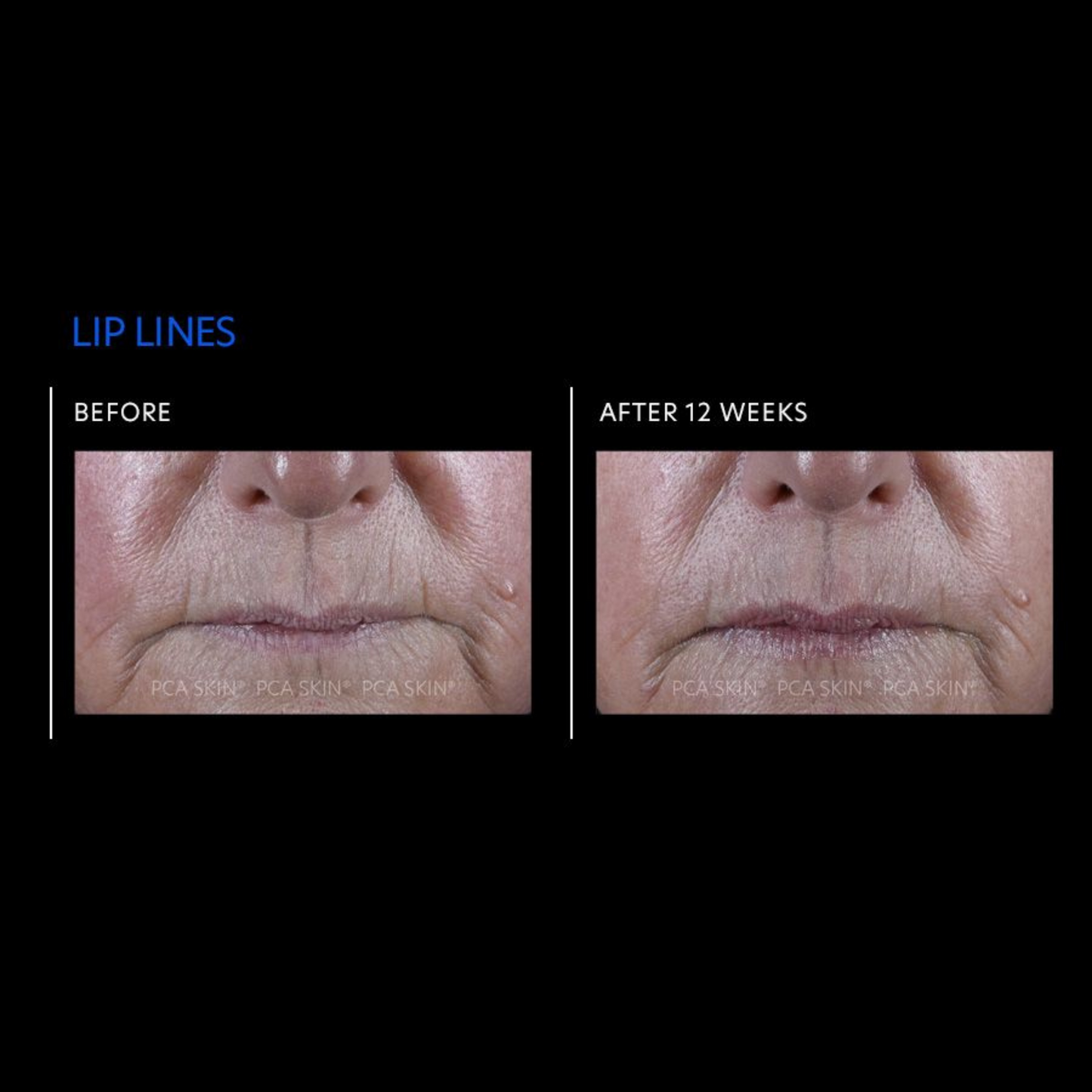 ExLinea® Pro Peptide Serum | PCA Skin