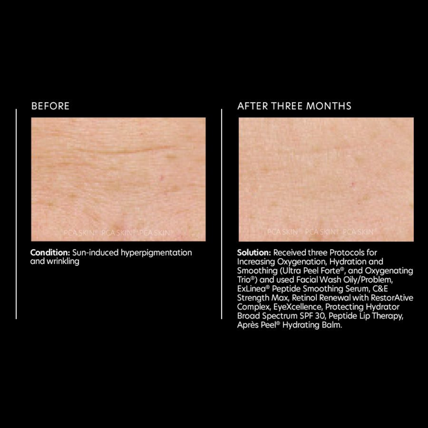 ExLinea® Peptide Smoothing Serum | PCA Skin