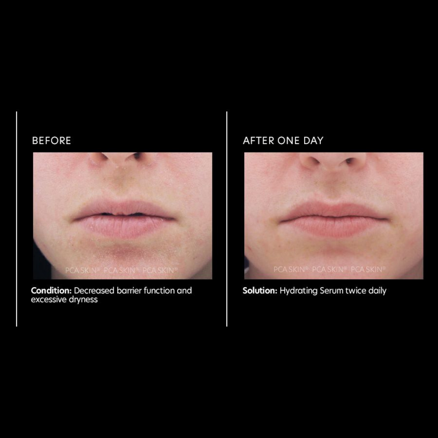 Hydrating Serum | PCA Skin