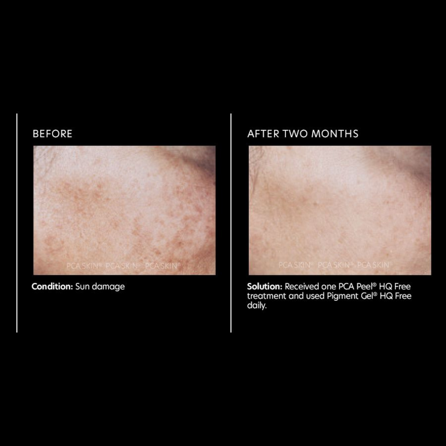 Pigment Gel® HQ Free | PCA Skin