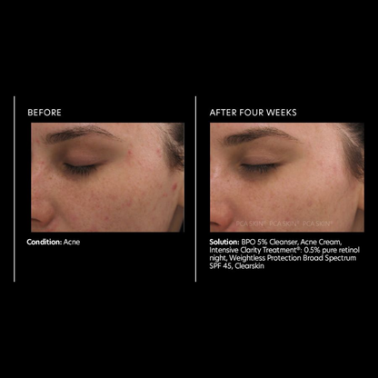 Intensive Clarity Treatment®: 0.5% pure retinol &amp; salicylic acid | PCA Skin