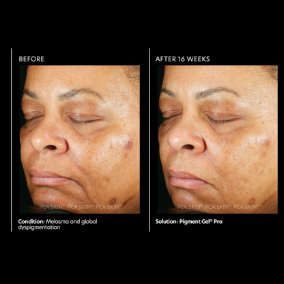 Pigment Gel® Pro  | PCA Skin